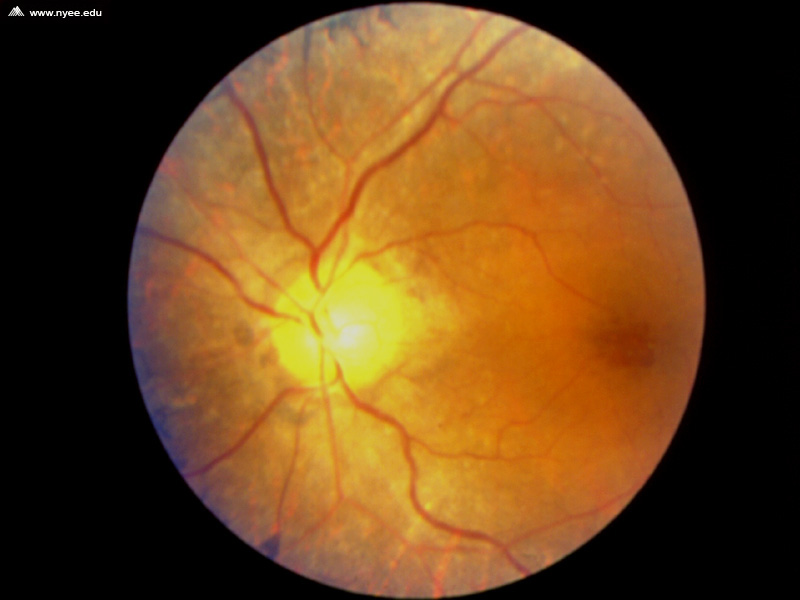 retinitis pigmentosa latest research